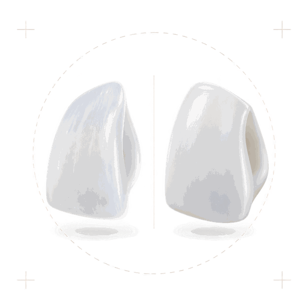 Comparação entre uma lâmina de lente de contato dental ultrafina e uma faceta de porcelana mais espessa