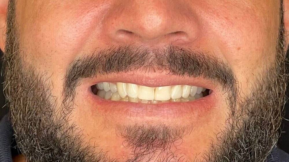 Sorriso do Daniel antes do tratamento, dentes desgastados e amarelados