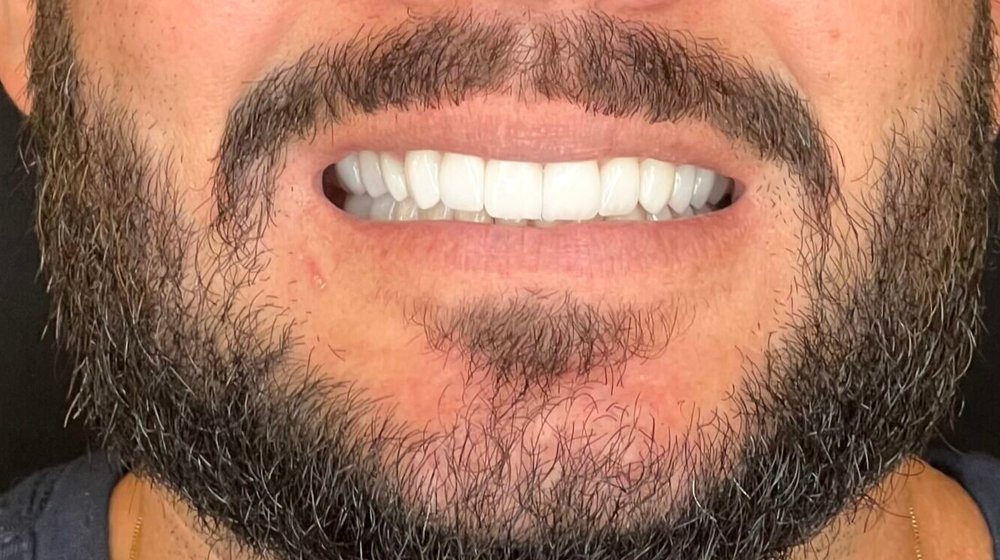 Sorriso do Daniel depois das lentes de contato dental na Clínica CZN, dentes alinhados e de aparência natural
