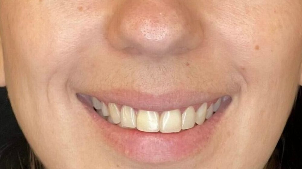 Sorriso de Marina antes do tratamento na Clínica CZN
