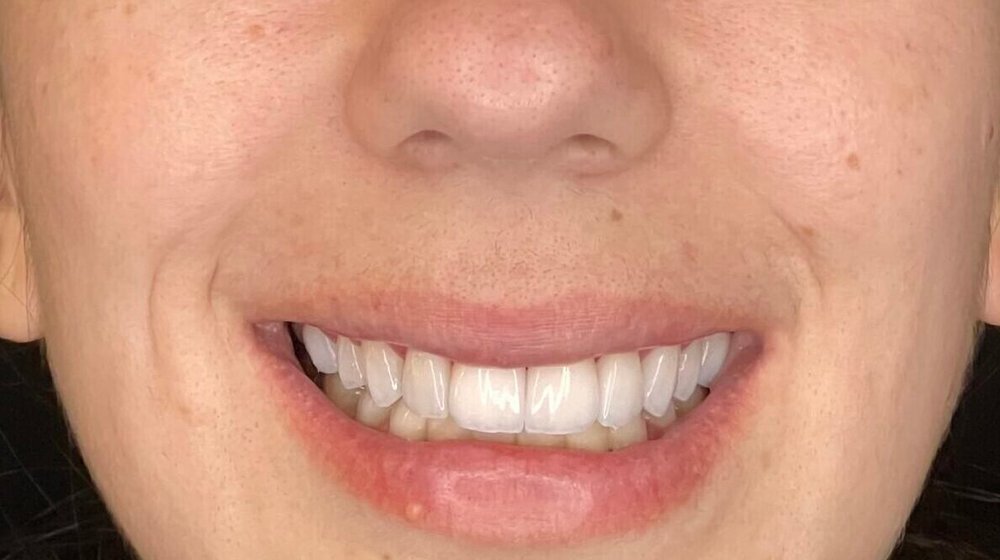 Sorriso de Marina depois do tratamento na Clínica CZN