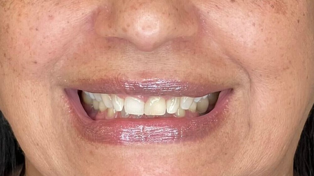 Sorriso de Naires antes do tratamento na Clínica CZN