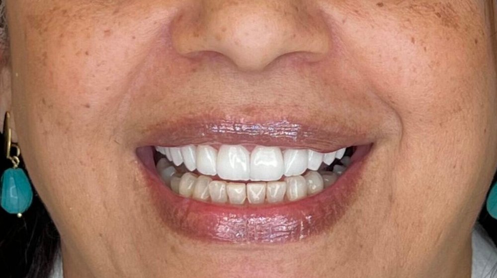 Sorriso de Naires depois do tratamento na Clínica CZN