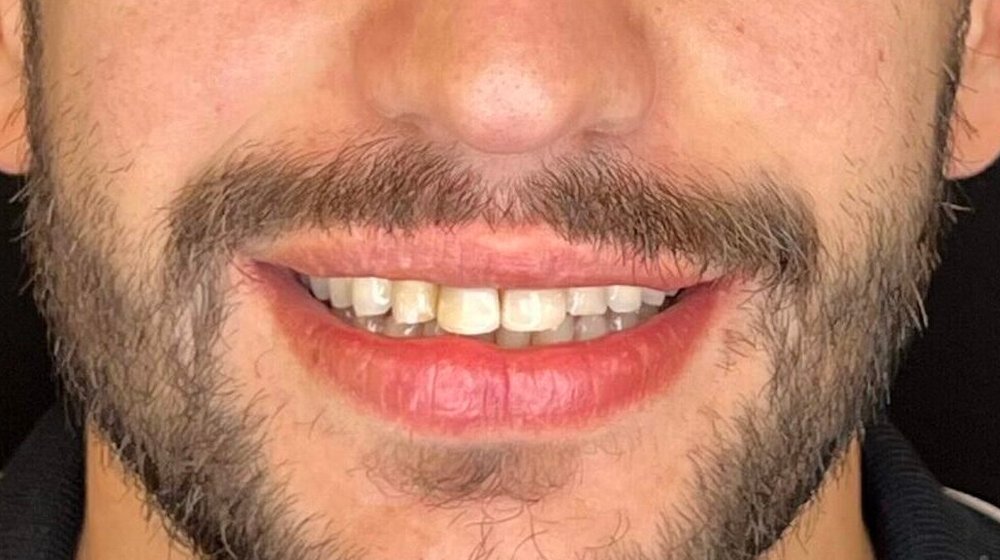 Sorriso de Thiago antes do tratamento na Clínica CZN